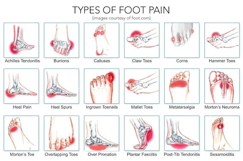 type of foot pain